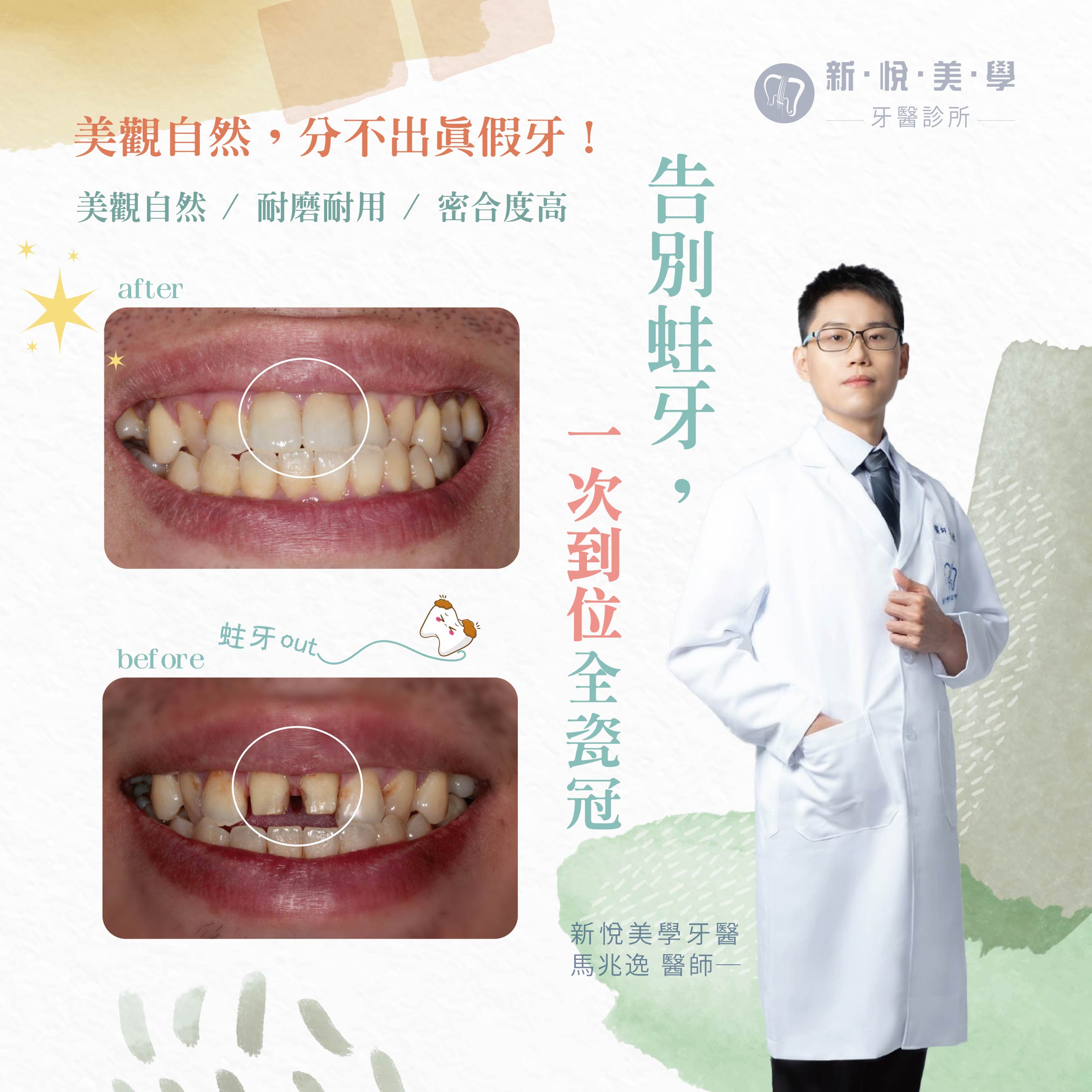 [新悅美學牙醫案例]  告別蛀牙，全瓷冠一次到位  的第1張圖片